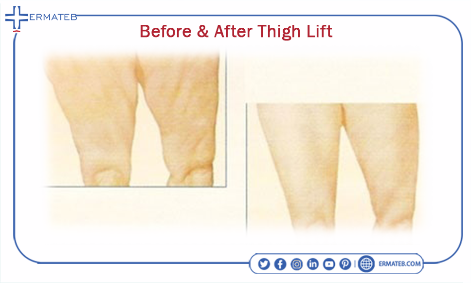 before & after thigh lift